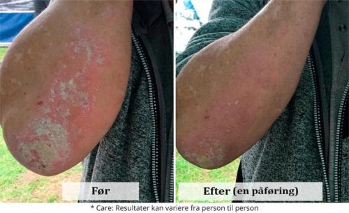 Psoriasis creme før og efter billede